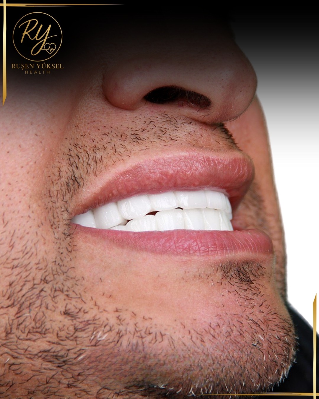 Diş Tedavileri (İmplant, Hollywood Smile, Kaplama)