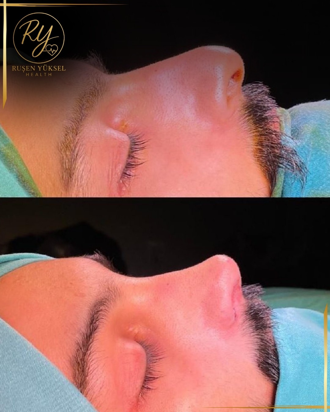 Rinoplasti (Burun Estetiği)